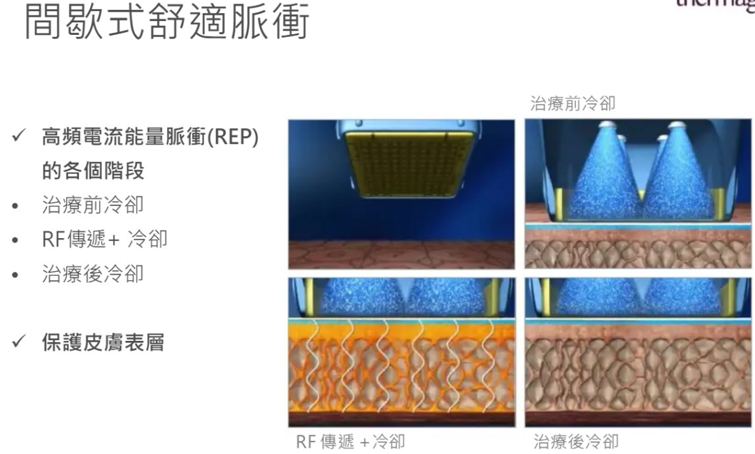 耦合剂怎么加热热玛吉100问（1）_https://www.jmylbn.com_新闻资讯_第6张