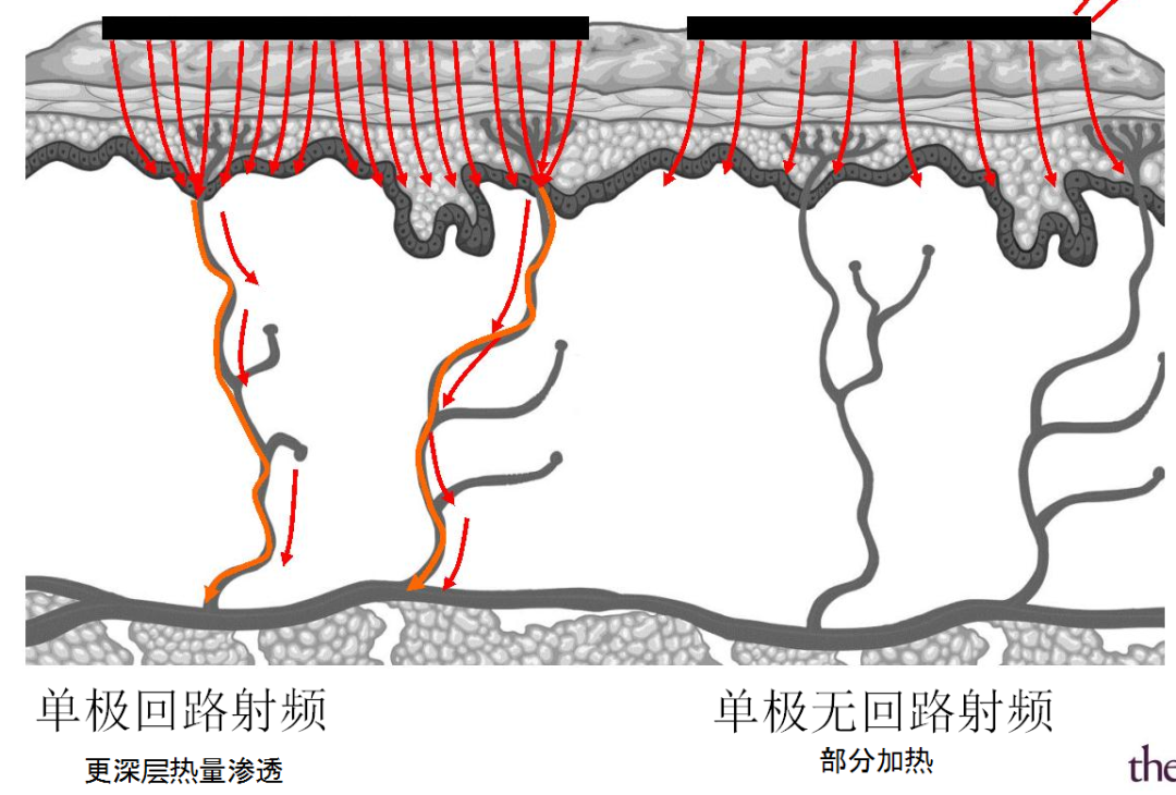 耦合剂怎么加热热玛吉100问（1）_https://www.jmylbn.com_新闻资讯_第2张