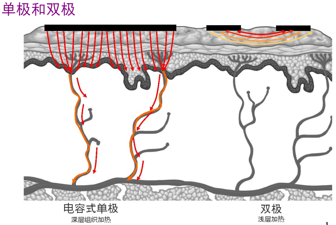 耦合剂怎么加热热玛吉100问（1）_https://www.jmylbn.com_新闻资讯_第3张