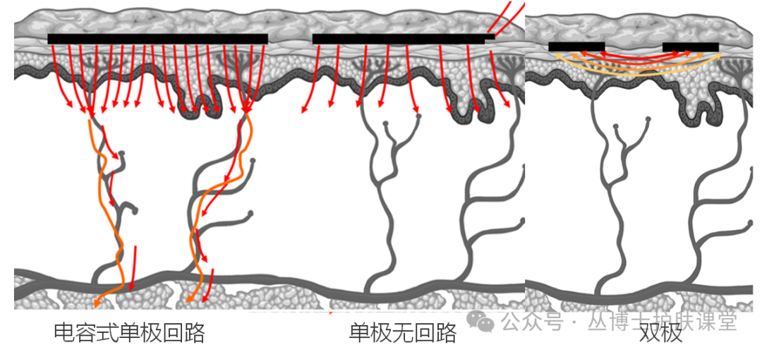 多极射频是什么《医用射频皮肤美容与治疗专家共识》解读（1）射频的分类与作用原理_https://www.jmylbn.com_新闻资讯_第8张