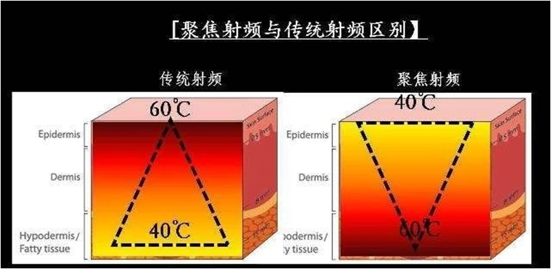 耦合剂怎么加热热玛吉100问（1）_https://www.jmylbn.com_新闻资讯_第12张
