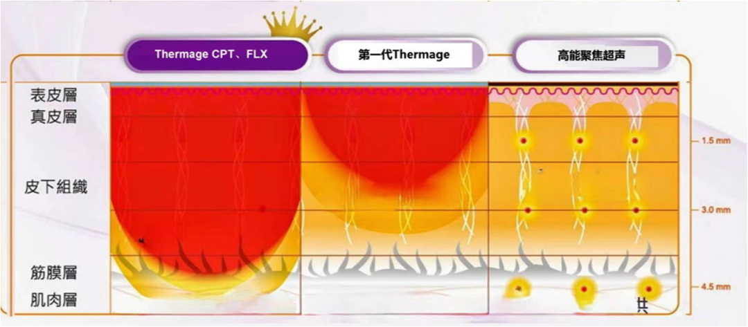 耦合剂怎么加热热玛吉100问（1）_https://www.jmylbn.com_新闻资讯_第10张