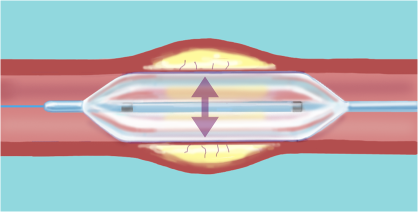 【练兵专辑】| 省司法警察医院成功完成首例pta(动静脉内瘘球囊扩张成