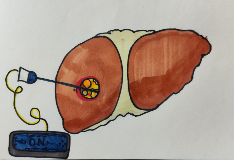 微波针是什么【临床前沿】一根针“烧死”肿瘤，市一医院应用微波消融技术治疗肝癌_https://www.jmylbn.com_新闻资讯_第6张