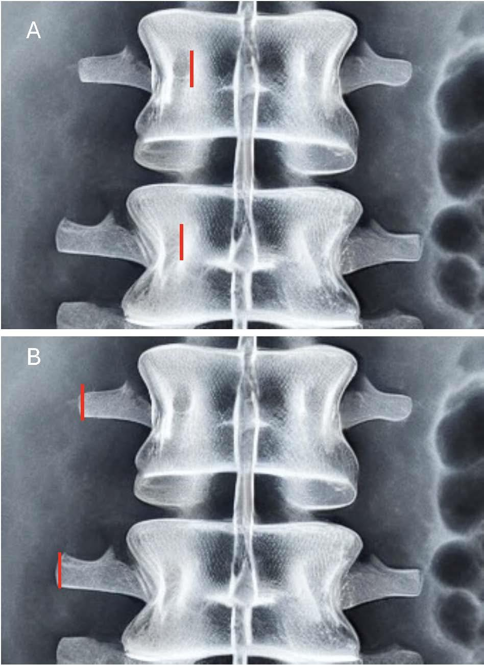 单侧双通道内镜手术(UBE)入门：初学者技术概述