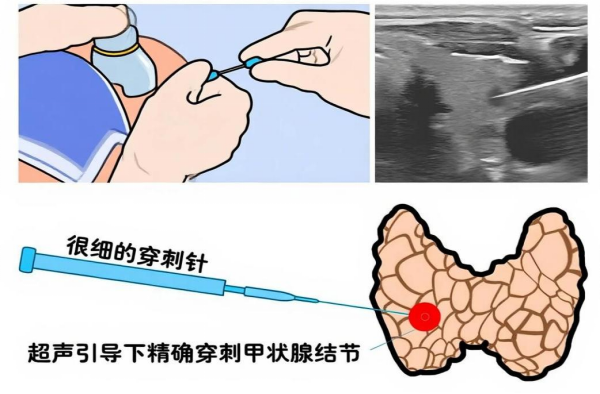 穿刺活检枪怎么用超声界的“狙击枪”：介入超声——不开刀也能精准治肿瘤​_https://www.jmylbn.com_新闻资讯_第5张
