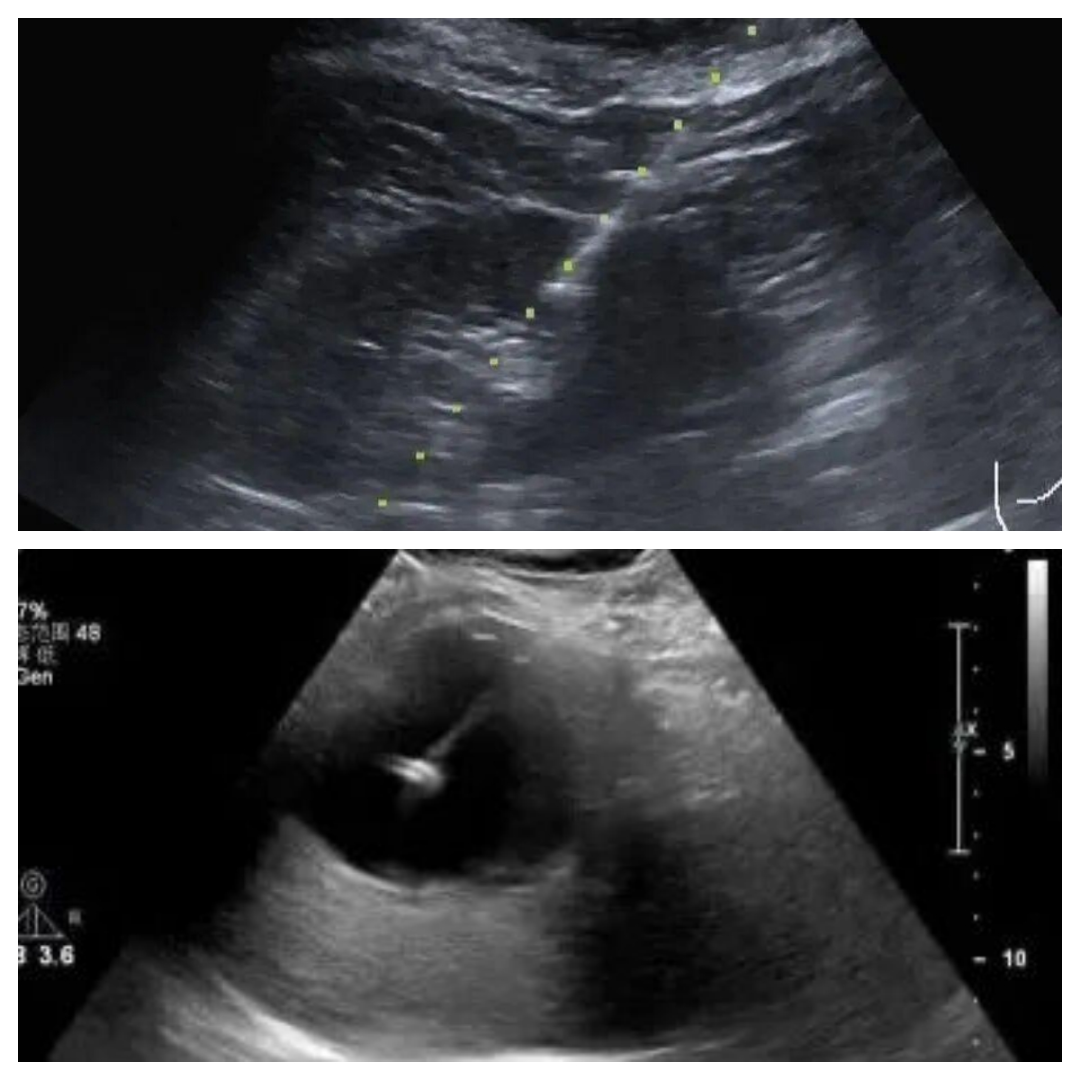 穿刺活检枪怎么用超声界的“狙击枪”：介入超声——不开刀也能精准治肿瘤​_https://www.jmylbn.com_新闻资讯_第6张