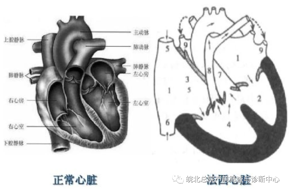 室间隔缺损,主动脉骑跨和右心室肥大(虽然后者在胎儿期一般不会出现)