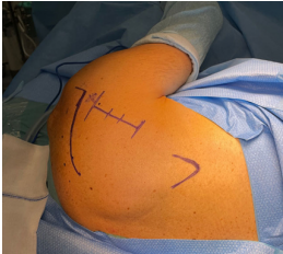 肩胛骨骨折微创入路MIPO技术详解