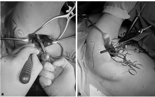 肩胛骨骨折微创入路MIPO技术详解
