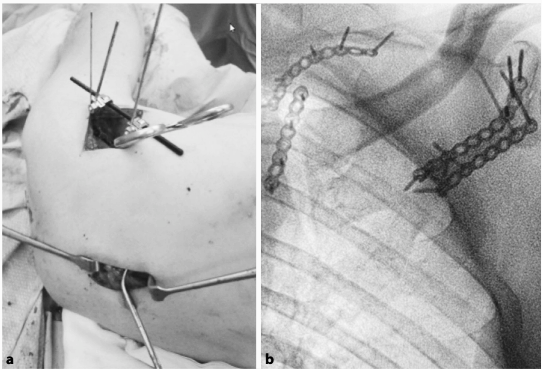 肩胛骨骨折微创入路MIPO技术详解