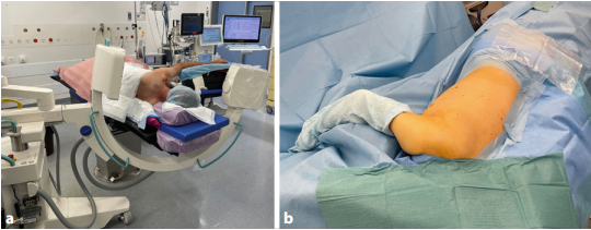 肩胛骨骨折微创入路MIPO技术详解