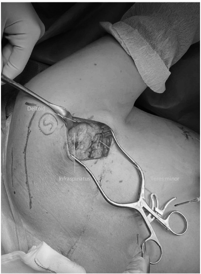 肩胛骨骨折微创入路MIPO技术详解