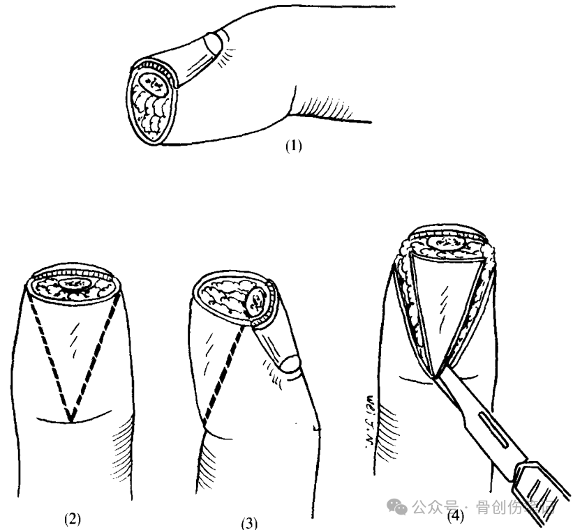 指端缺损的经典皮瓣：V-Y推进术