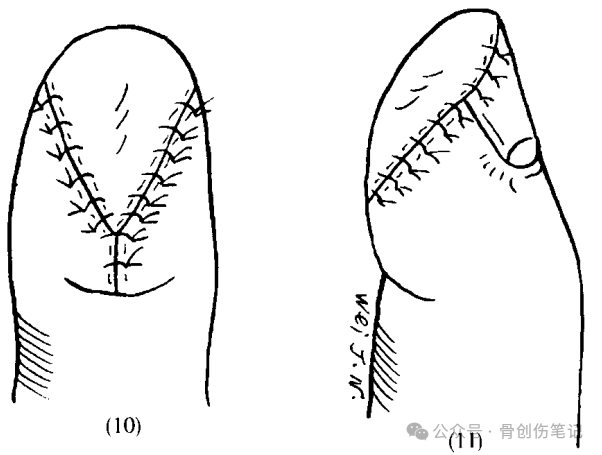 指端缺损的经典皮瓣：V-Y推进术
