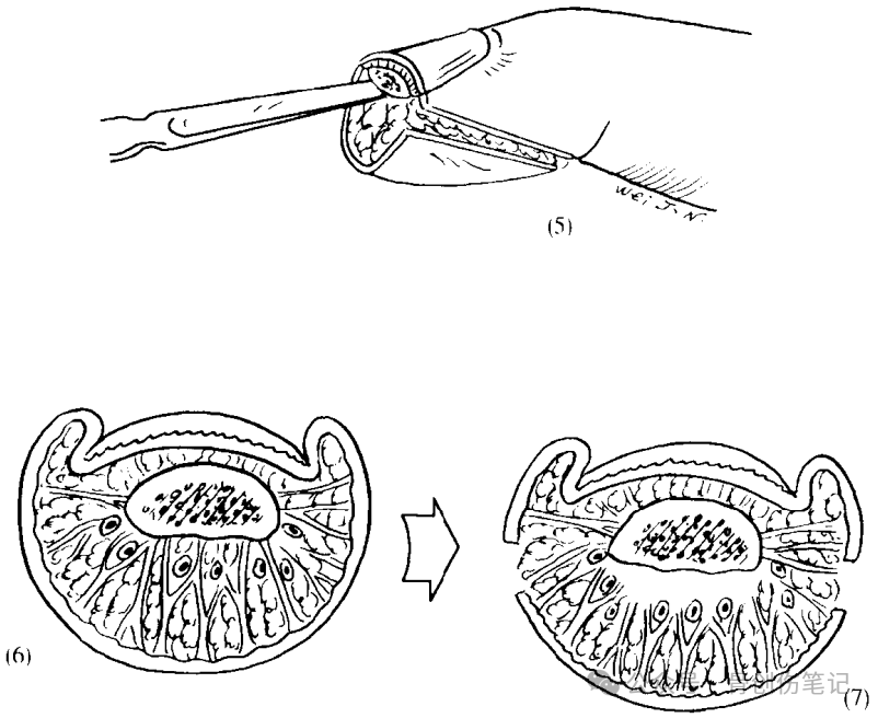 指端缺损的经典皮瓣：V-Y推进术