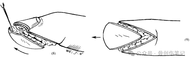 指端缺损的经典皮瓣：V-Y推进术