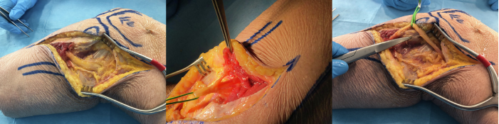 一篇关于改良Frosch入路治疗后外侧胫骨平台骨折的技术说明