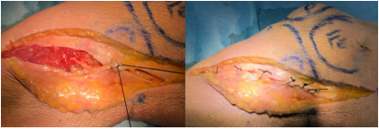 一篇关于改良Frosch入路治疗后外侧胫骨平台骨折的技术说明