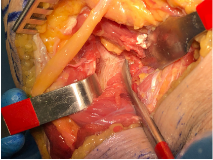 一篇关于改良Frosch入路治疗后外侧胫骨平台骨折的技术说明