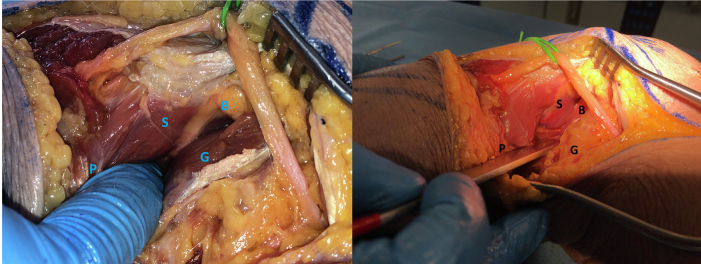 一篇关于改良Frosch入路治疗后外侧胫骨平台骨折的技术说明
