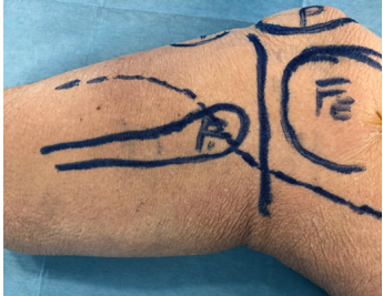 一篇关于改良Frosch入路治疗后外侧胫骨平台骨折的技术说明