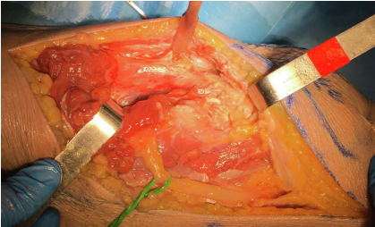一篇关于改良Frosch入路治疗后外侧胫骨平台骨折的技术说明