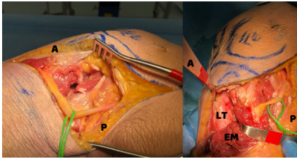 一篇关于改良Frosch入路治疗后外侧胫骨平台骨折的技术说明