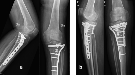 一篇关于改良Frosch入路治疗后外侧胫骨平台骨折的技术说明