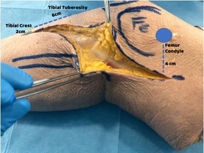 一篇关于改良Frosch入路治疗后外侧胫骨平台骨折的技术说明