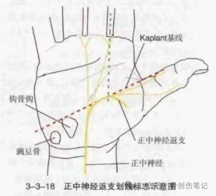 微创掌侧小切口治疗腕管综合征