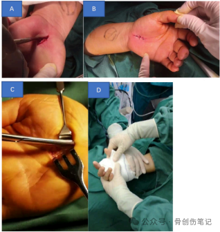 微创掌侧小切口治疗腕管综合征
