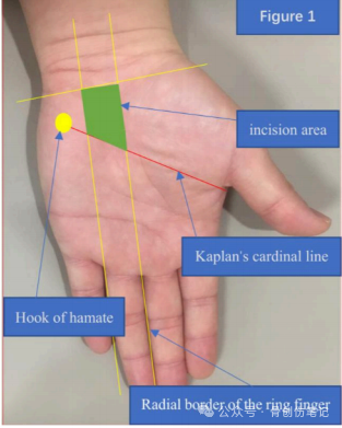 微创掌侧小切口治疗腕管综合征