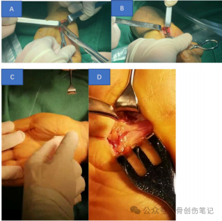 微创掌侧小切口治疗腕管综合征