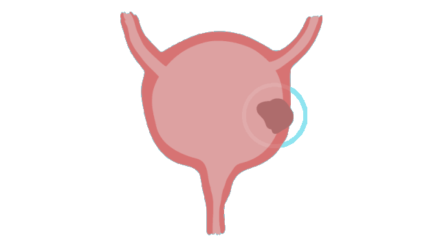 b膀胱镜为什么消毒泌尿外科的第三只眼睛——膀胱镜_https://www.jmylbn.com_新闻资讯_第2张