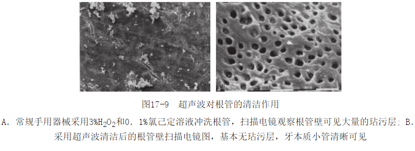 为什么要用根管马达（第122期）根管预备新技术_https://www.jmylbn.com_新闻资讯_第7张