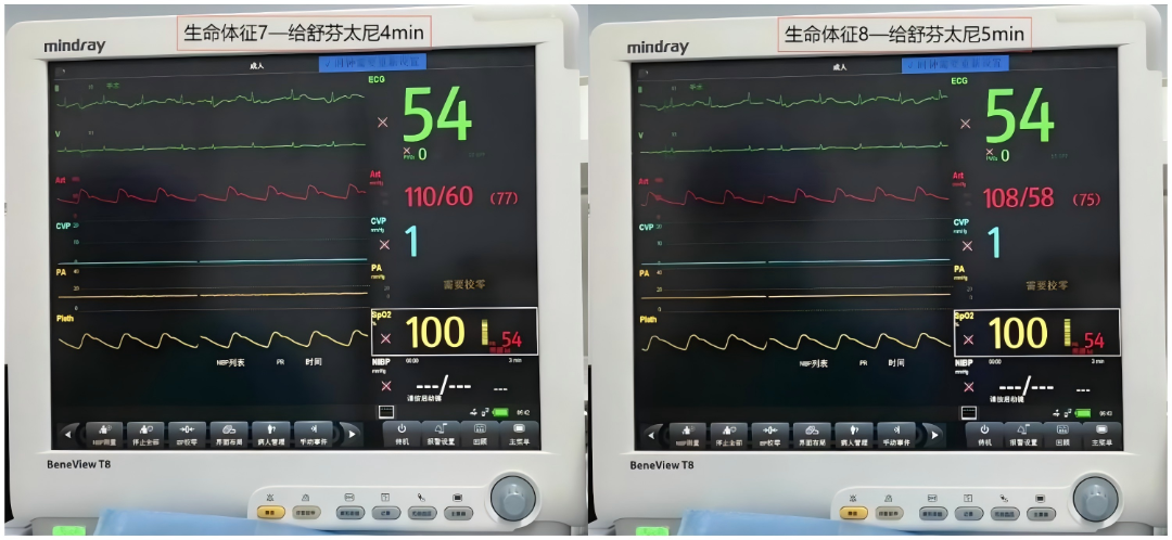 大腿取钢丝怎么麻醉【七思麻想】命悬一线，钢丝绳上守平衡 ——1例高龄重症冠心病患者麻醉诱导管理_https://www.jmylbn.com_新闻资讯_第10张