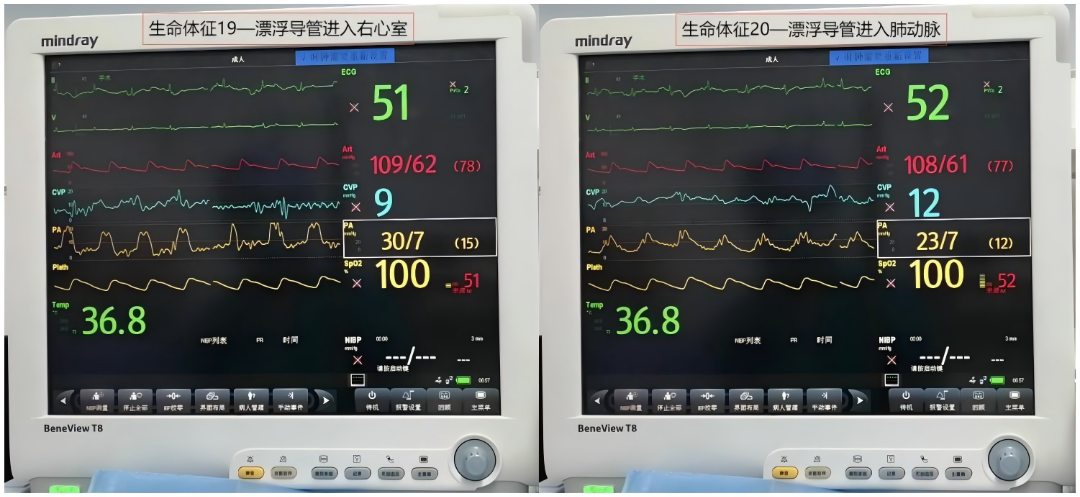 大腿取钢丝怎么麻醉【七思麻想】命悬一线，钢丝绳上守平衡 ——1例高龄重症冠心病患者麻醉诱导管理_https://www.jmylbn.com_新闻资讯_第16张