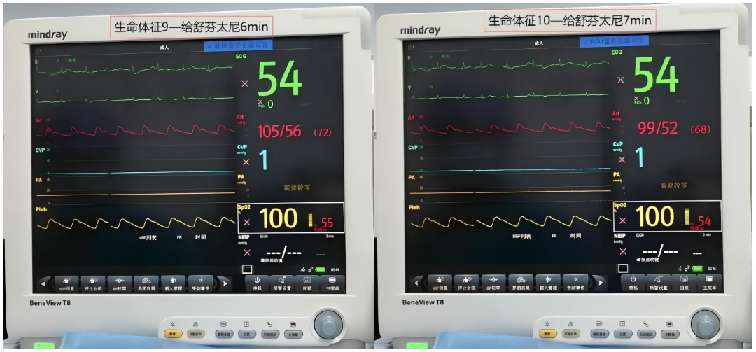 大腿取钢丝怎么麻醉【七思麻想】命悬一线，钢丝绳上守平衡 ——1例高龄重症冠心病患者麻醉诱导管理_https://www.jmylbn.com_新闻资讯_第11张