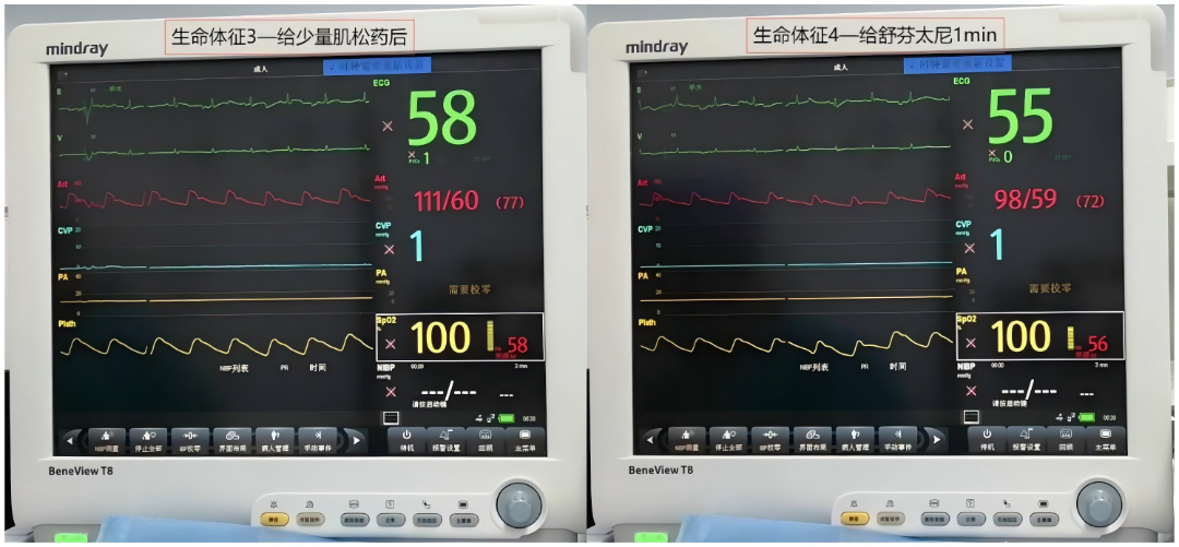 大腿取钢丝怎么麻醉【七思麻想】命悬一线，钢丝绳上守平衡 ——1例高龄重症冠心病患者麻醉诱导管理_https://www.jmylbn.com_新闻资讯_第8张