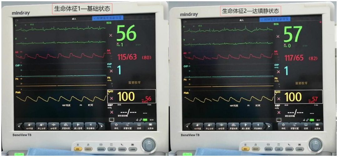 大腿取钢丝怎么麻醉【七思麻想】命悬一线，钢丝绳上守平衡 ——1例高龄重症冠心病患者麻醉诱导管理_https://www.jmylbn.com_新闻资讯_第7张