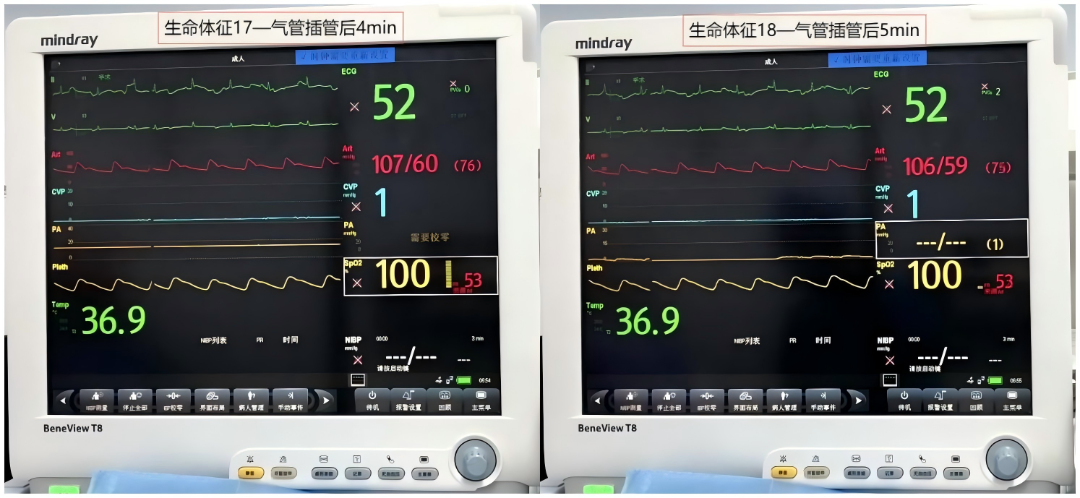 大腿取钢丝怎么麻醉【七思麻想】命悬一线，钢丝绳上守平衡 ——1例高龄重症冠心病患者麻醉诱导管理_https://www.jmylbn.com_新闻资讯_第15张