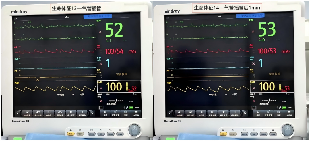 大腿取钢丝怎么麻醉【七思麻想】命悬一线，钢丝绳上守平衡 ——1例高龄重症冠心病患者麻醉诱导管理_https://www.jmylbn.com_新闻资讯_第13张