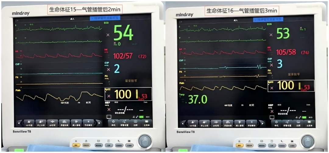 大腿取钢丝怎么麻醉【七思麻想】命悬一线，钢丝绳上守平衡 ——1例高龄重症冠心病患者麻醉诱导管理_https://www.jmylbn.com_新闻资讯_第14张