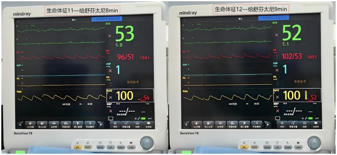 大腿取钢丝怎么麻醉【七思麻想】命悬一线，钢丝绳上守平衡 ——1例高龄重症冠心病患者麻醉诱导管理_https://www.jmylbn.com_新闻资讯_第12张