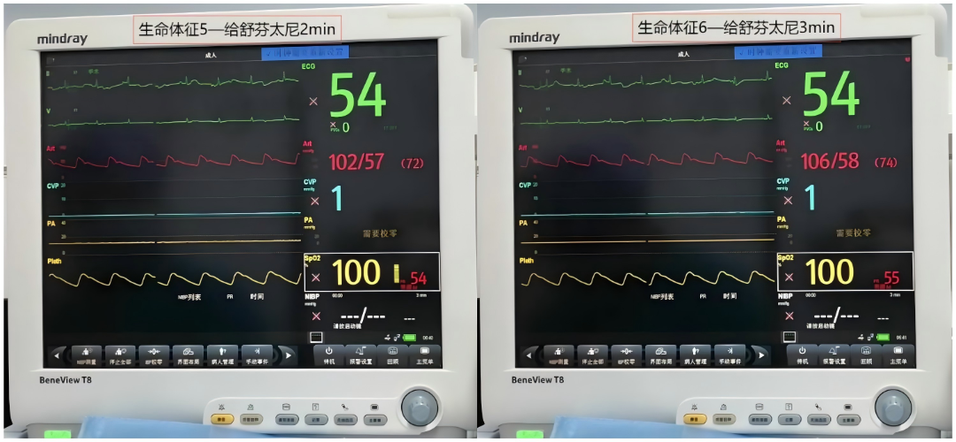 大腿取钢丝怎么麻醉【七思麻想】命悬一线，钢丝绳上守平衡 ——1例高龄重症冠心病患者麻醉诱导管理_https://www.jmylbn.com_新闻资讯_第9张
