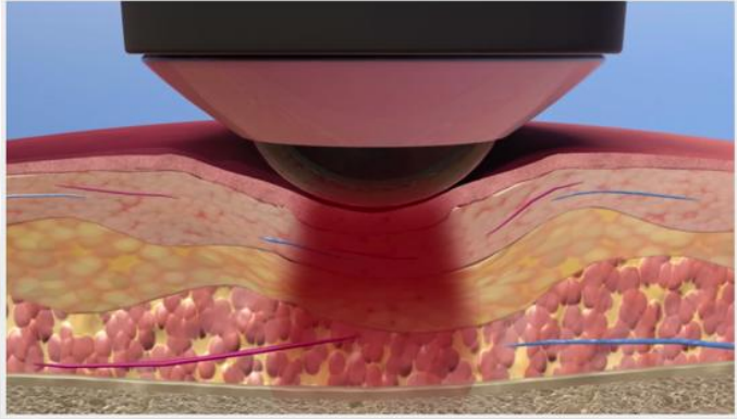 激光理疗有什么作用高能量激光疗法丨理疗技术的里程碑，深度疼痛的希望之光_https://www.jmylbn.com_新闻资讯_第15张