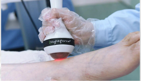 激光理疗有什么作用高能量激光疗法丨理疗技术的里程碑，深度疼痛的希望之光_https://www.jmylbn.com_新闻资讯_第22张