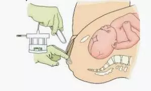 吸引器怎么握视频讲解：胎头吸引器手术的11个操作要点，助产士都要掌握_https://www.jmylbn.com_新闻资讯_第4张