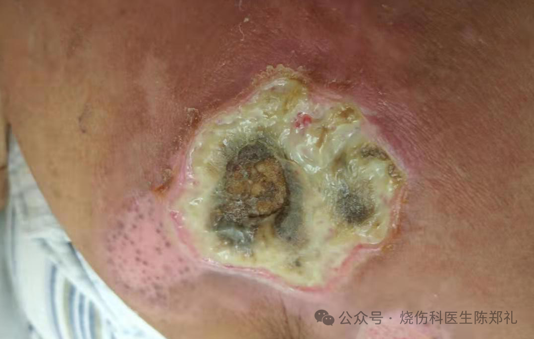 烧伤敷料怎么用图解创面外用药物及敷料系列丨油性药膏的原理及注意事项_https://www.jmylbn.com_新闻资讯_第11张